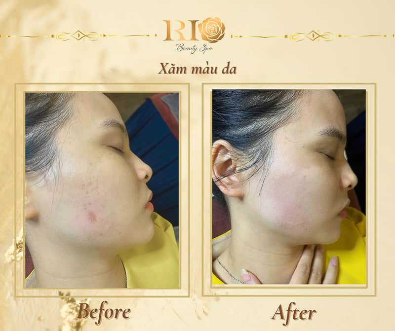 Khắc phục mất sắc tố da sau khi bôi thuốc trị nám bằng kỹ thuật xăm màu da che sẹo.