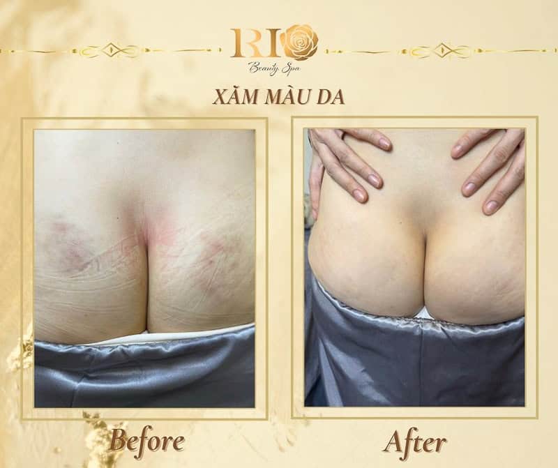 Kết quả thực hiện xăm màu da che sẹo và vết thâm vùng mông tại Rio Beauty Clinic.