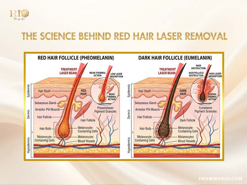 A diagram comparing hair follicles with pheomelanin versus eumelanin to explain the science of laser hair removal for red hair.