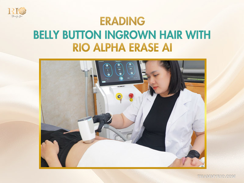 A practitioner performing laser treatment to remove belly button ingrown hair with Rio Alpha Erase AI technology.