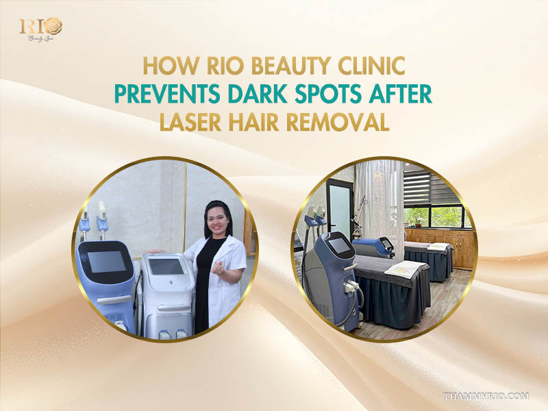 Rio Beauty Clinic prevents black spots after laser hair removal using advanced laser technology and professional treatment rooms, as shown in these circular inset photos.