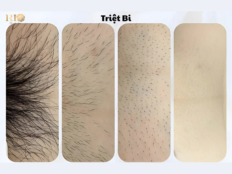 A professional setup for Brazilian Laser Hair Removal at Rio Beauty Clinic, demonstrating the safe and hygienic process of hair removal brazilian laser for international clients.
