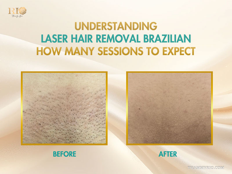 Before and after results of skin treatment to understand brazilian laser hair removal how many sessions to expect.