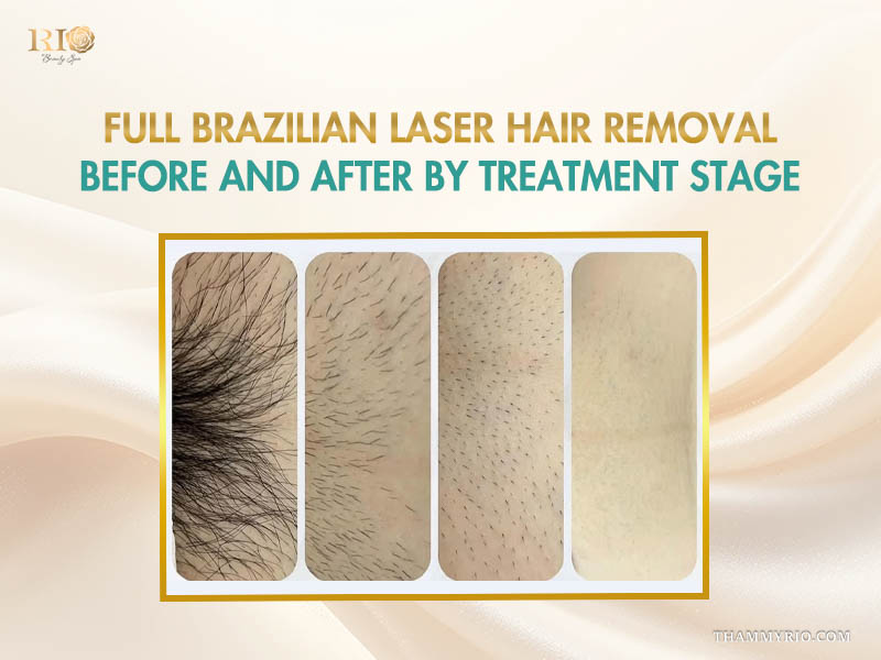 Real full brazilian laser hair removal before and after photos displaying successful results after treatment.