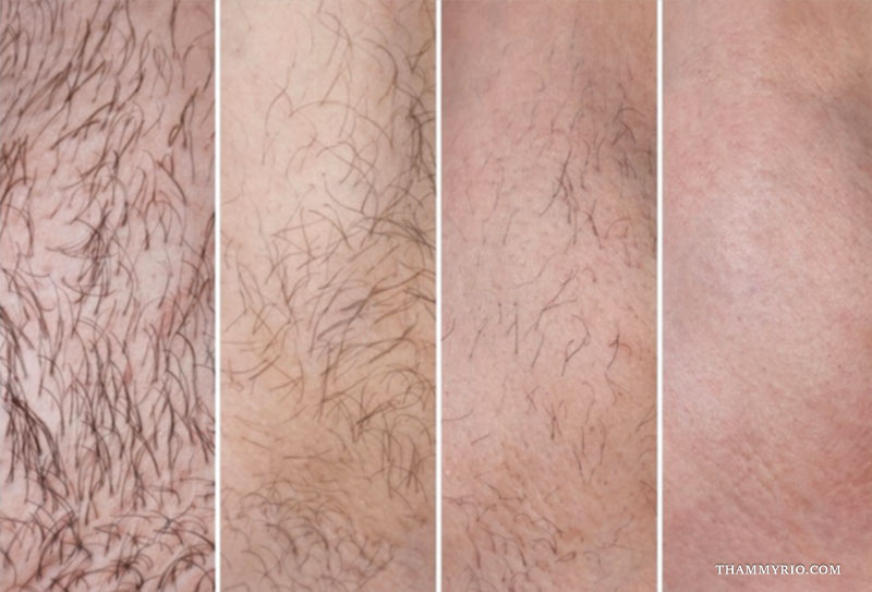 Full brazilian laser hair removal before and after photos showing 70-80% hair reduction after the second session.