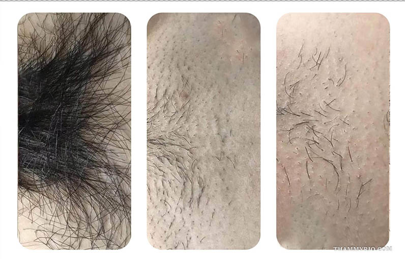 Two real full brazilian laser hair removal before and after photos showing visible results after the first session.