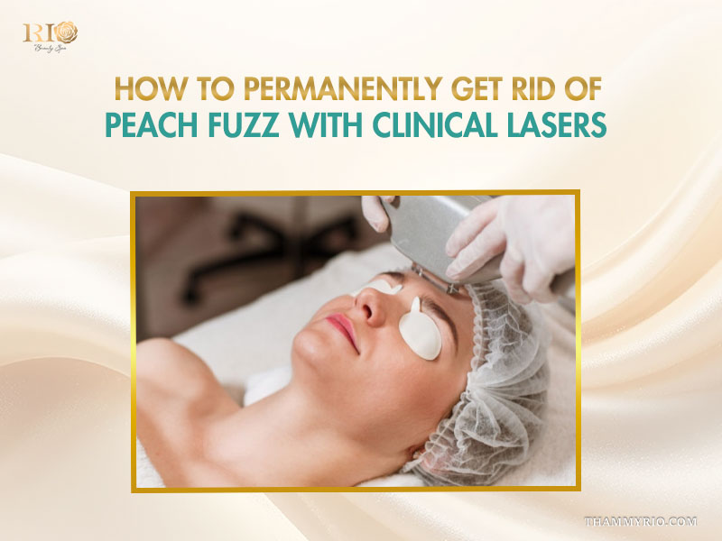 Professional laser treatment for getting rid of peach fuzz at Rio Beauty Clinic.