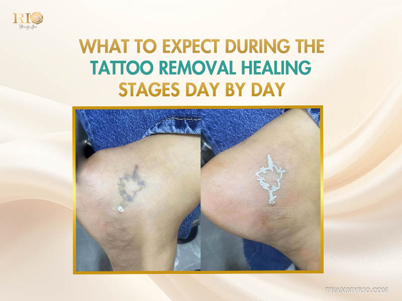 A close-up view showing the progression of healed tattoo removal on the ankle, featuring white frosting effect immediately after laser treatment.