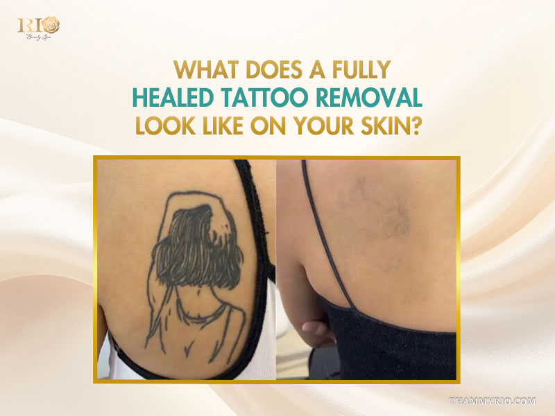 Before and after comparison of a fully healed tattoo removal procedure on the back at Rio Beauty Clinic.
