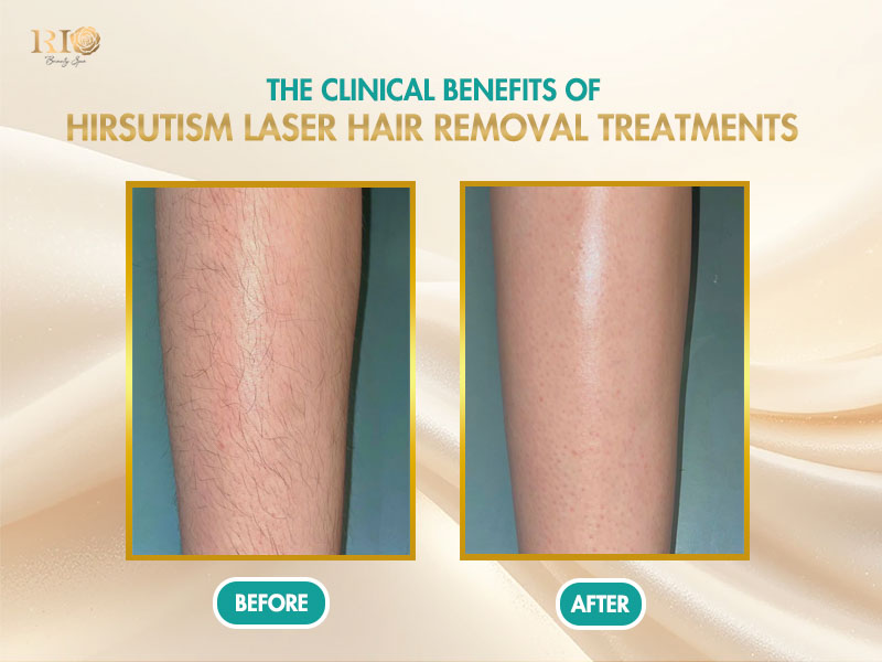Clinical results of hirsutism laser hair removal treatment showing significant hair reduction.
