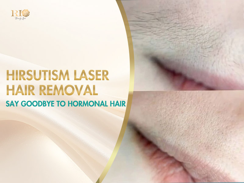 Facial hirsutism laser hair removal results showing smooth skin after treatment.