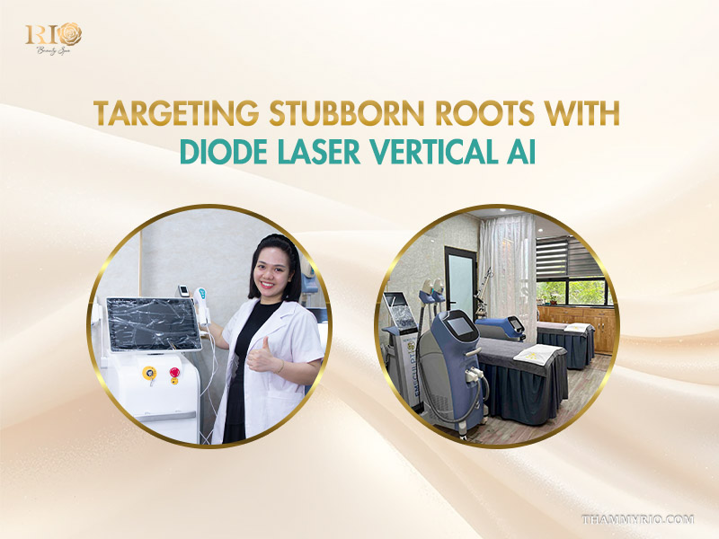 A specialist with Diode Laser Vertical AI technology for stubborn roots, a modern upgrade for those asking how can i remove facial hair naturally.