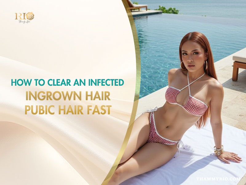 Woman resting by a pool, illustrating tips on how to clear an infected ingrown hair pubic hair fast.