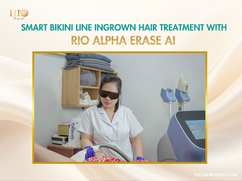 A technician performing a smart bikini line ingrown hair treatment using the Rio Alpha Erase AI technology.
