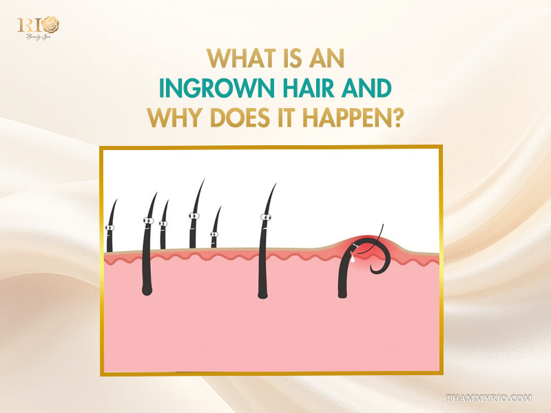 Illustration showing the process of ingrown hair and why professional ingrown hair removal is necessary.