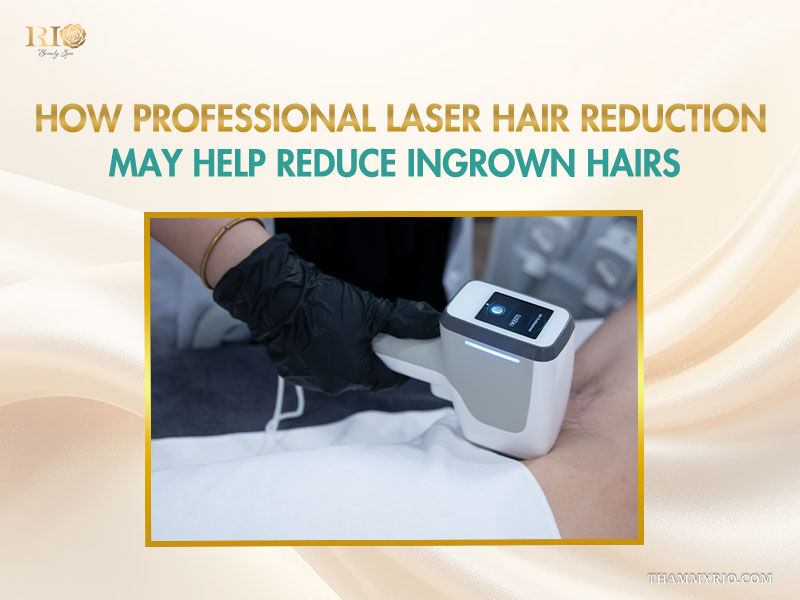 Technician using advanced laser technology for effective ingrown hair removal at Rio Beauty Clinic.