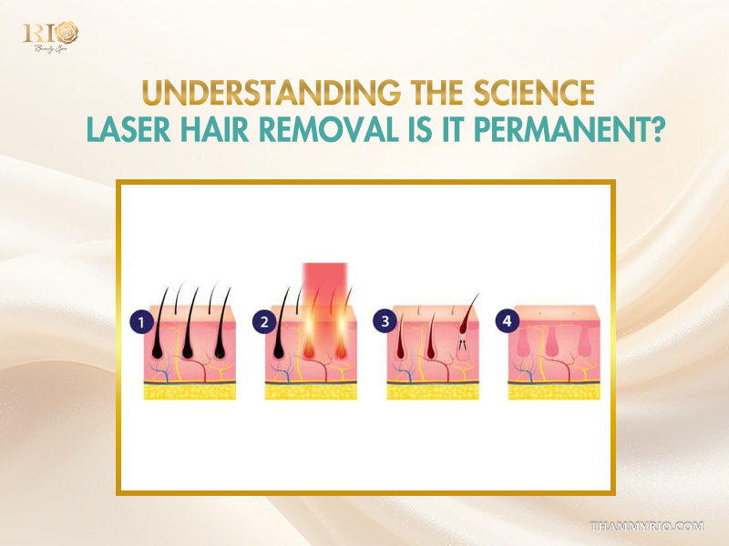 Scientific diagram of 4 stages explaining is laser hair removal permanent by Rio Beauty Spa.