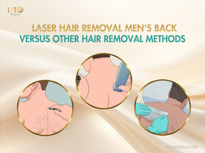 Comparison of laser back hair removal for men versus traditional methods like shaving, using creams, and waxing.