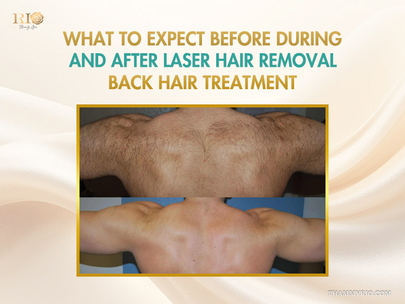 Before and after results of a male client undergoing professional laser back hair removal at Rio Beauty Clinic.