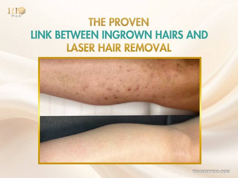 Before and after skin comparison explaining the connection of laser hair removal and ingrown hairs treatment