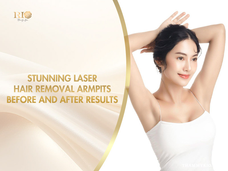 Woman showcasing smooth skin from laser hair removal armpits before and after results at Rio Beauty Spa.