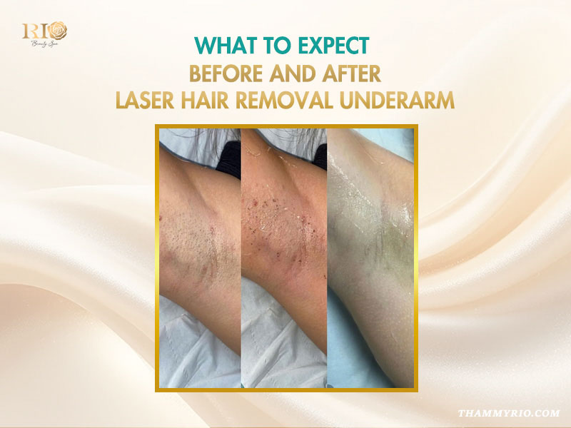 Underarm skin progress showing before and after laser hair removal stages for armpits.