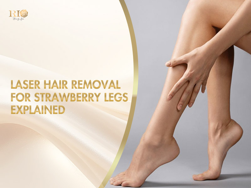 A woman’s smooth legs with laser hair removal for strawberry legs treatment.