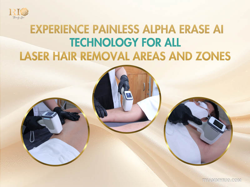 Promotional banner for painless Alpha Erase AI technology for all laser hair removal zones treatment at Rio Beauty Clinic.