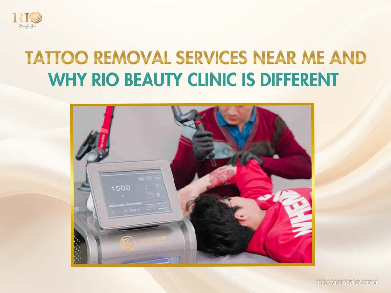 Professional laser tattoo removal before and after process using advanced technology at Rio Beauty Clinic.