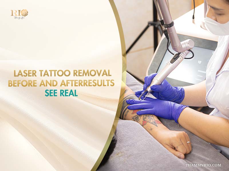 Real laser tattoo removal before and after session in progress at Rio Beauty Clinic.