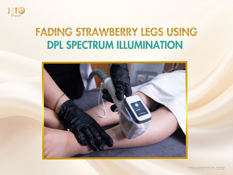 A specialist performing a leg hair removal treatment using DPL spectrum illumination to fade strawberry legs.