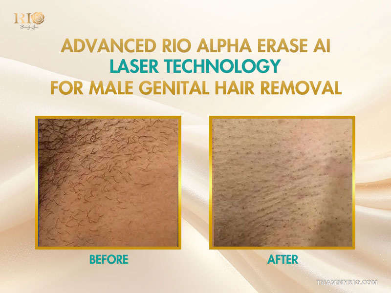 Real before and after results of smooth skin from a customized Men Public Hair Removal treatment at Rio Clinic.