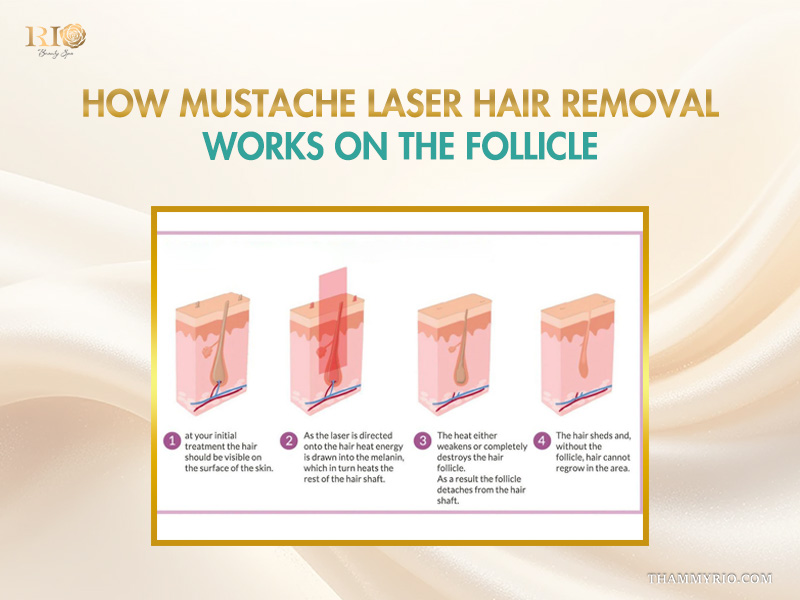 Diagram showing how mustache laser hair removal works on the hair follicle in four steps.