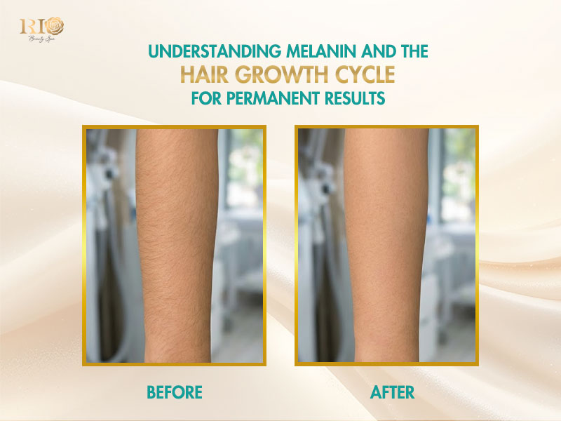 Before and after charts illustrating pubic area laser hair removal effects on hair follicles and growth cycles.