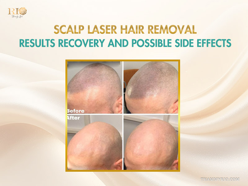 Before and after scalp laser hair removal results at Rio Beauty Clinic.