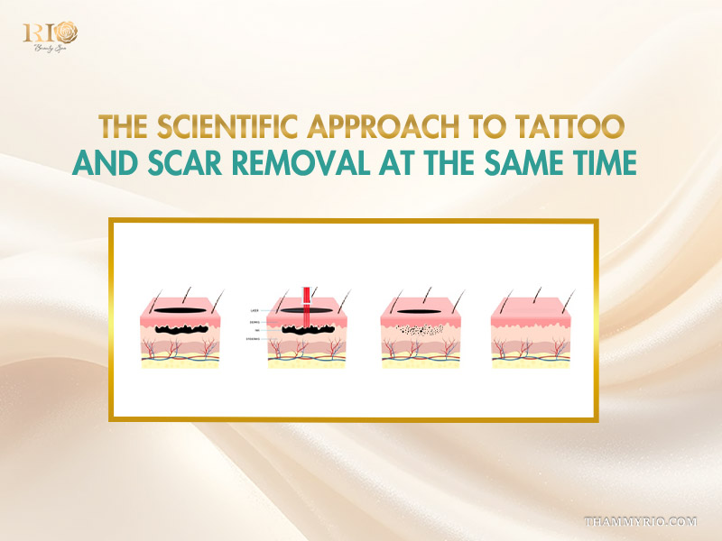 Laser treatment process for scarred tattoo removal at Rio Beauty Clinic.