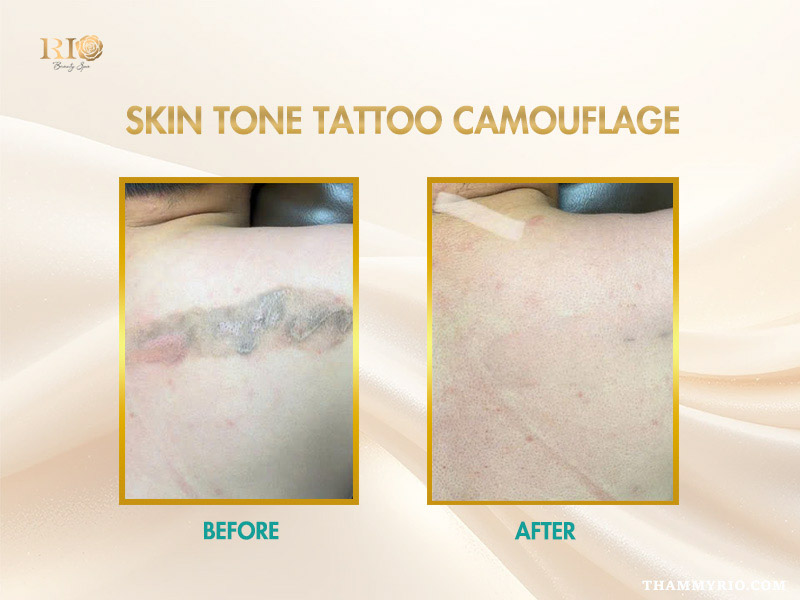 Expert performing Skin tone tattoo cover up after laser removal process