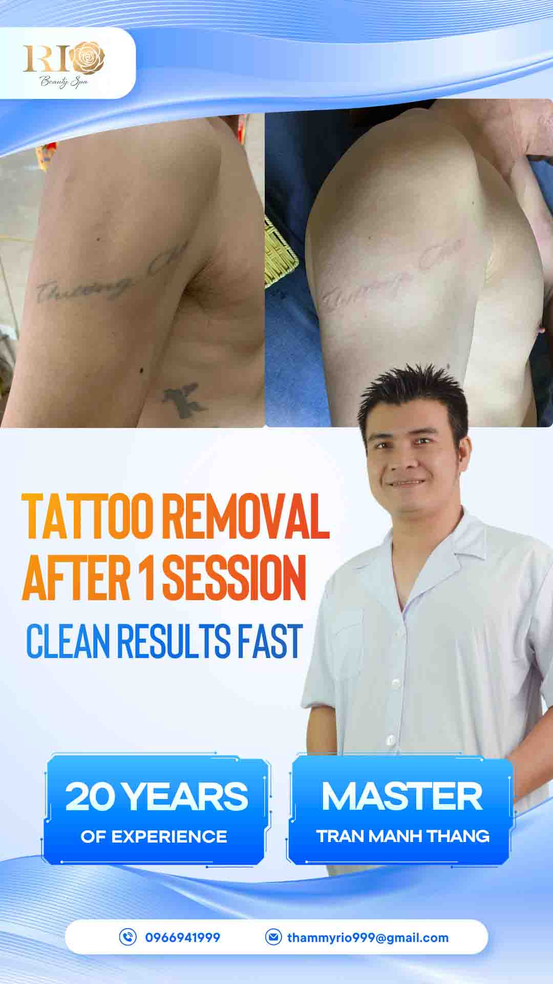 Professional tattoo removal after 1 session using advanced Rio Laser Ultra Series.