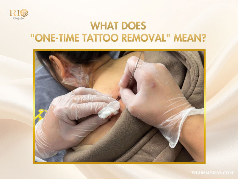 Rio Beauty Clinic professional tattoo removal after 1 session with laser technology