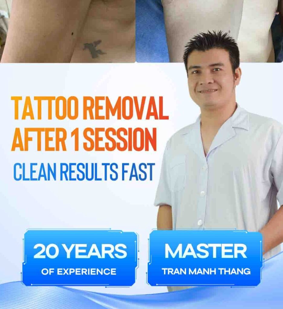 Highly effective tattoo removal after 1 session with Rio Laser Ultra Series.