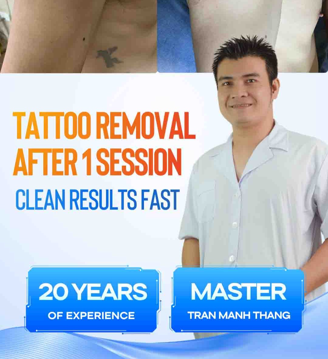 Highly effective tattoo removal after 1 session with Rio Laser Ultra Series.