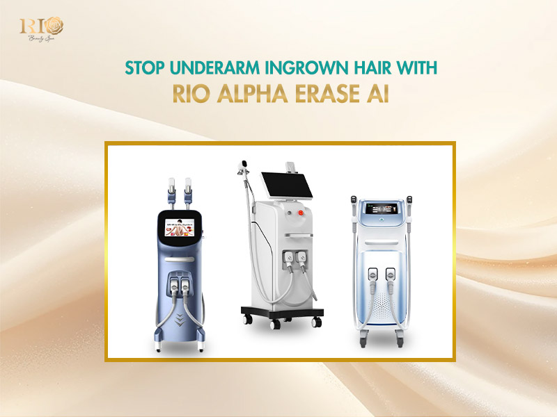 Rio Alpha Erase AI technology for effective treatment of underarm ingrown hair