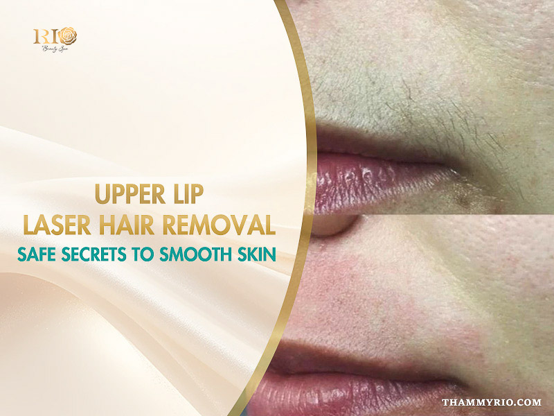 Close-up before and after results of upper lip laser hair removal at Thammyrio.com, showing smooth skin and hair reduction for a confident look.