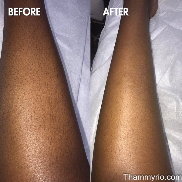 Vertical AI Diode Laser Technology reduces thick dark leg hair on melanin-rich skin with advanced AI-guided laser precision