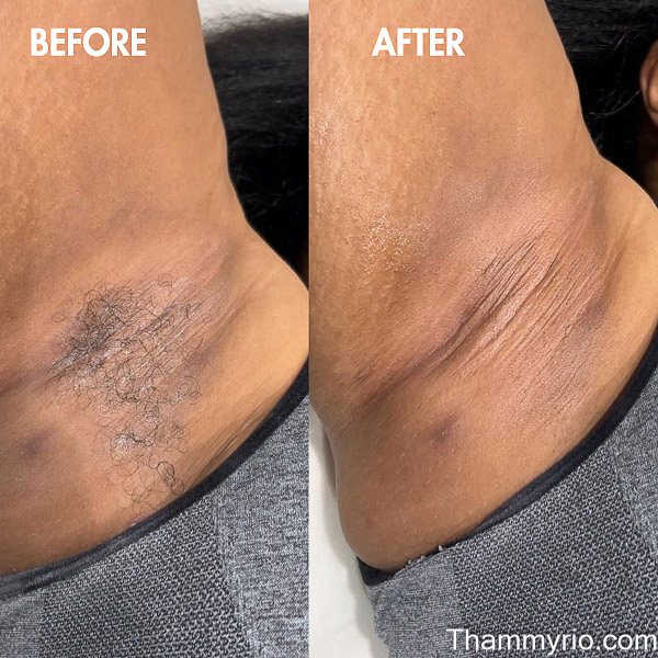 Vertical AI Diode Laser integrated with Rio Beauty Clinic advanced laser hair removal technologies for safe treatment results