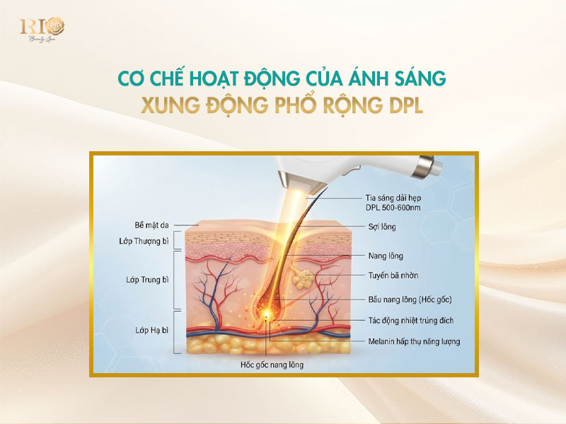 Cơ chế hoạt động của công nghệ triệt lông DPL Spectrum hiện đại