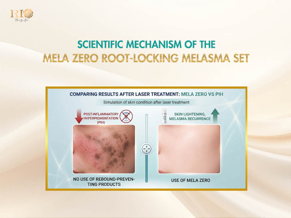 Mela Zero Skincare for post-laser pigmentation care and PIH prevention support