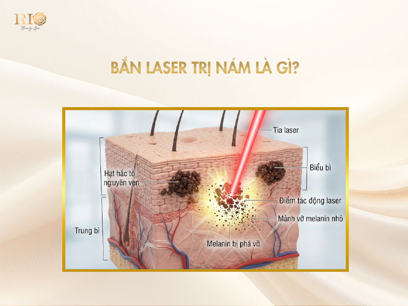 Cơ chế phương pháp bắn laser trị nám