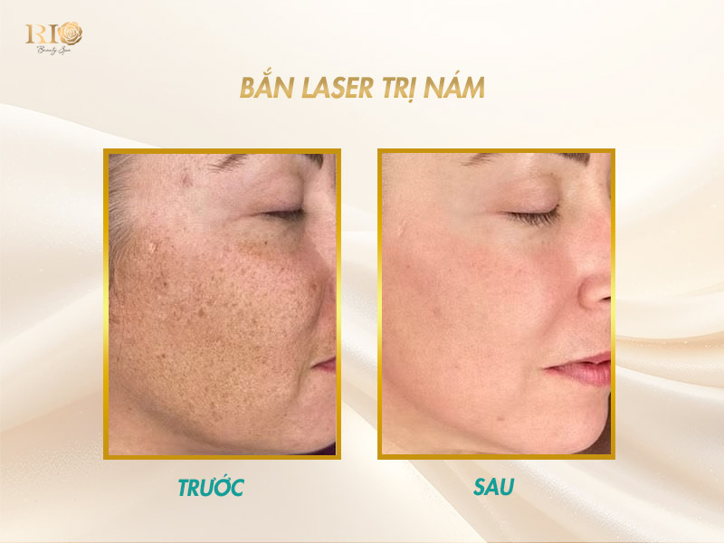 Hiệu quả trước sau khi bắn laser trị nám