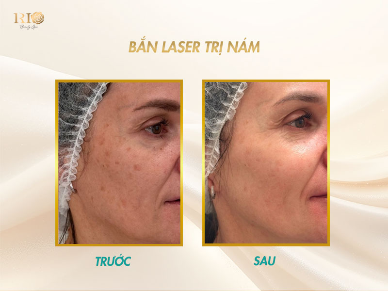 Kết quả thực tế khi bắn laser trị nám